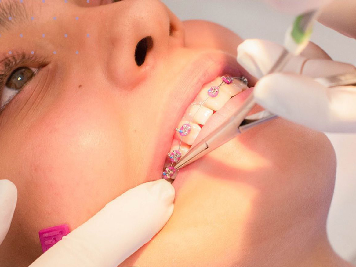 ORTODONCIA CONVENCIONAL